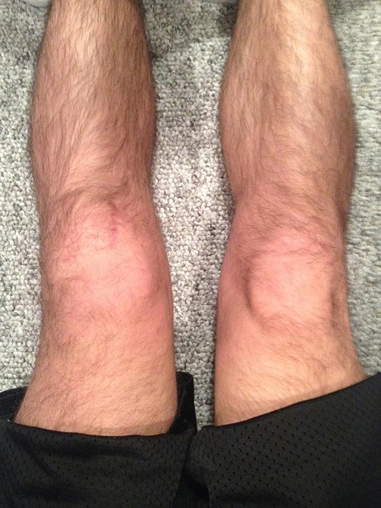 Should i sleep with my leg elevated after acl surgery Acl Reconstruction Surgery Blog