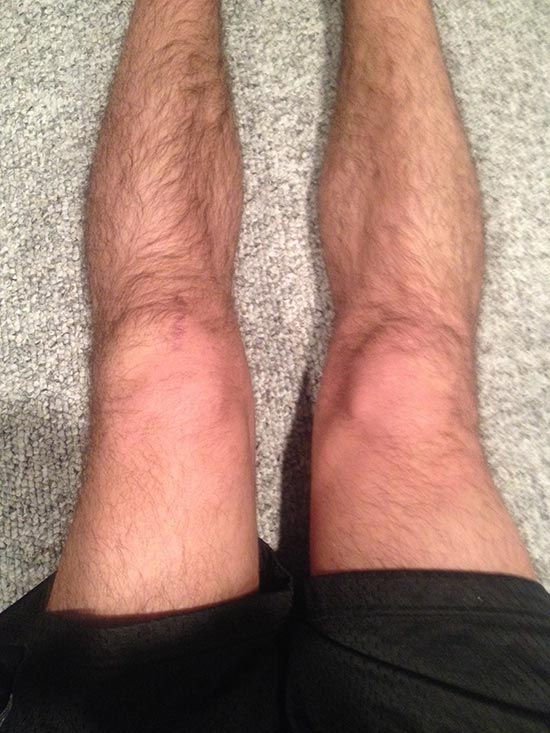 Should i sleep with my leg elevated after acl surgery Acl Reconstruction Surgery Blog
